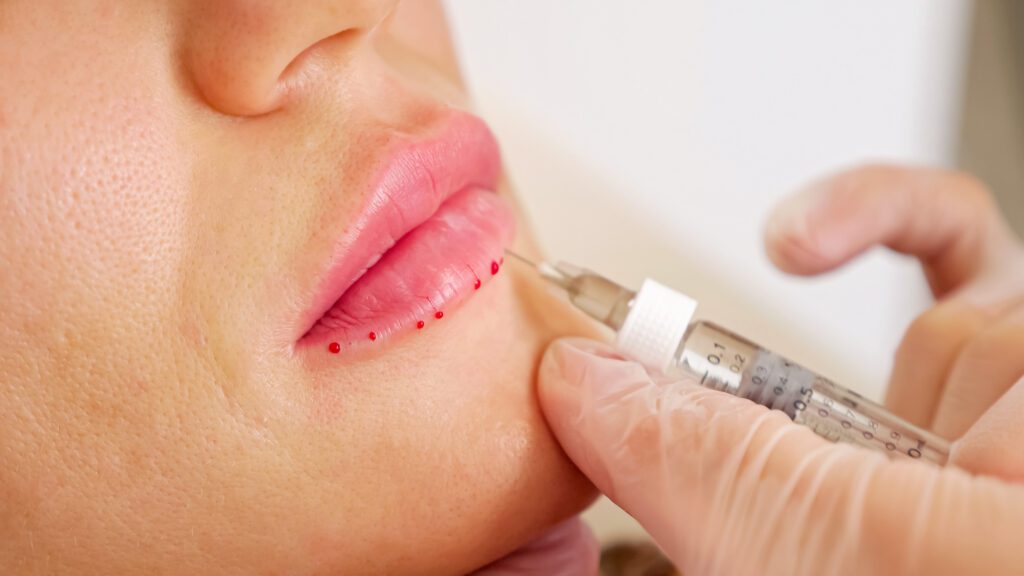 How Much Does Lip Filler Cost? A Comprehensive Guide