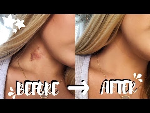 how to get rid of hickeys